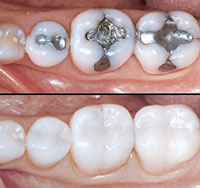 Dental Amalgams