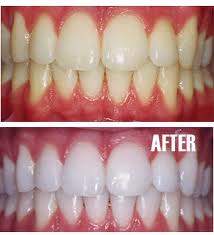 Bleaching Techniques by Lise Gula RDH