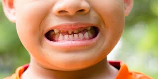 Sugar affects Children’s Teeth