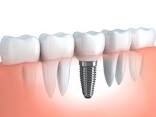 Options for Missing Teeth